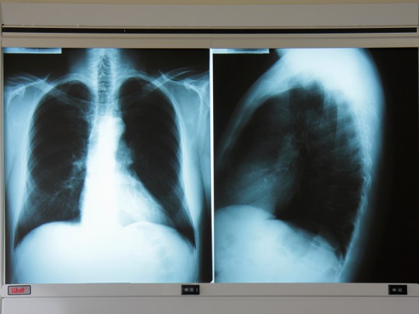 Florida, Miami Beach, Mt. Mount Sinai Medical Center, hospital, doctor's office, adult male chest x-ray, radiography, diagnosis, test, screening, lungs, heart, thorax, anterior, lateral, light box, film,