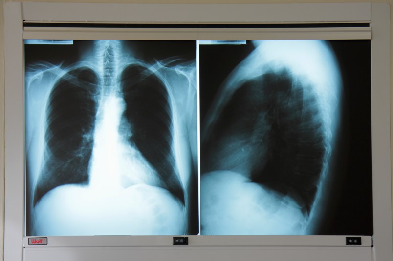 Florida, Miami Beach, Mt. Mount Sinai Medical Center, hospital, doctor's office, adult male chest x-ray, radiography, diagnosis, test, screening, lungs, heart, thorax, anterior, lateral, light box, film,